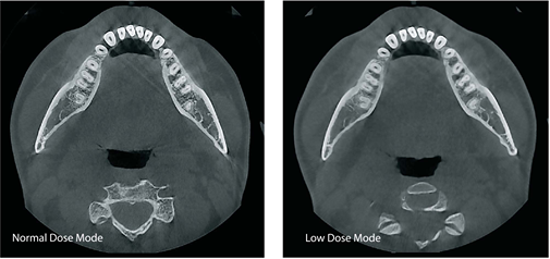 Dental CBCT Scan