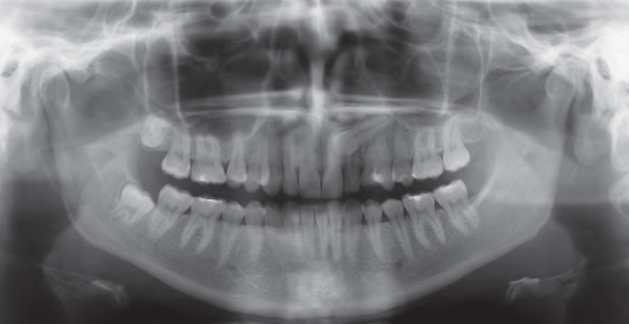 Gendex GXDP-700 Panoramic, Ceph plus CBCT