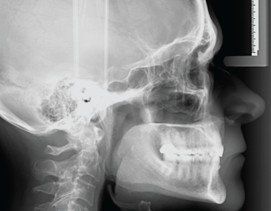 Gendex GXDP-700 Panoramic, Ceph plus CBCT