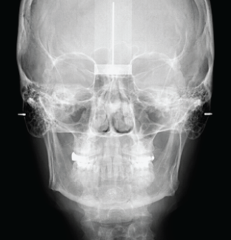 Gendex GXDP-700 Panoramic, Ceph plus CBCT