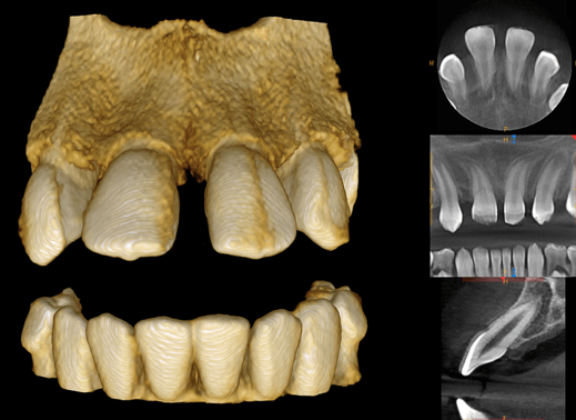 Carestream 9300 Select 3D Cone Beam and Panoramic X-ray