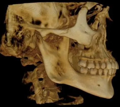 Carestream 9300 Select 3D Cone Beam and Panoramic X-ray