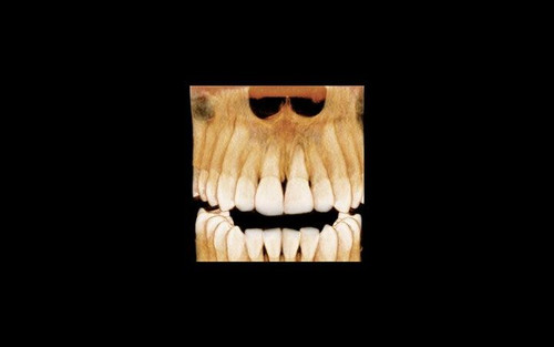Vatech PaX-i Green CT Panoramic + Cone Beam - 15x15 fov