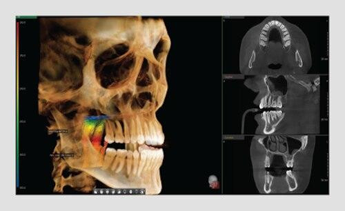 Vatech PaX-i Green CT Panoramic + Cone Beam - 15x15 fov