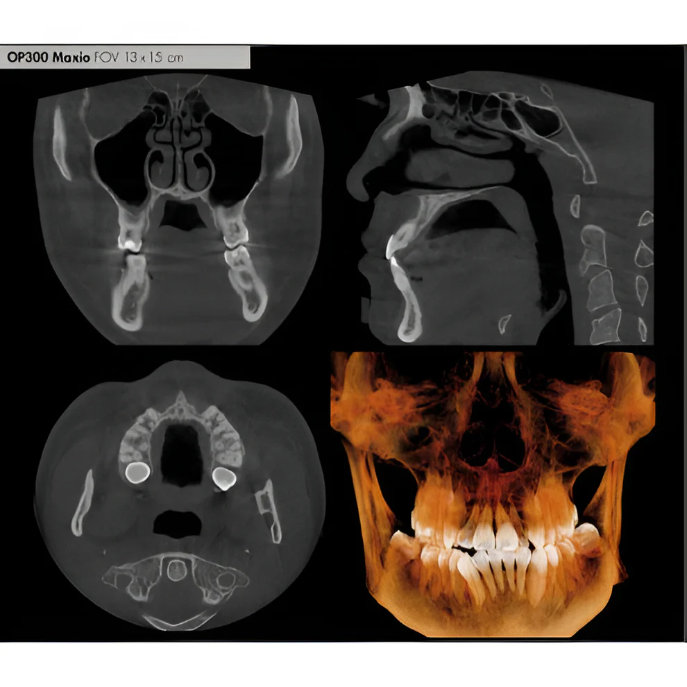Instrumentarium OP300 Maxio Pan + CBCT - 8x15 FOV