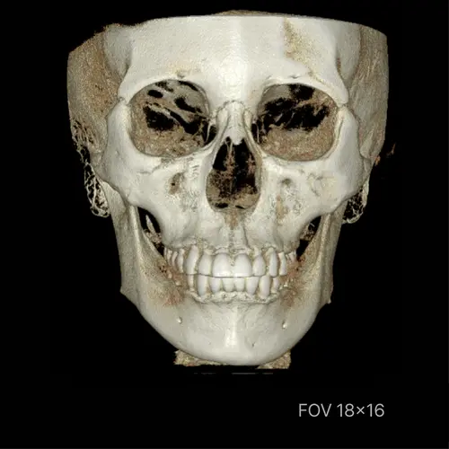 rayscan-vision-fov.webp