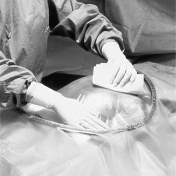 3M™ Steri-Drape™ Cesarean-Section Sheets & Pouches with Ioban 2 Incise Pouch, 77" x 122"