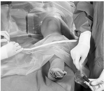 [1194] 3M™ Steri-Drape™ Arthroscopy Drapes, Fluid Collection Pouch, 89" x 120", 2 Exit Ports